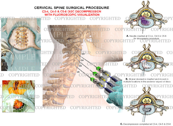 3 level - C3-4, C4-5 and C5-6 cervical spien decompression surgery with Czynności Obrońcy W Postępowaniu Karnym