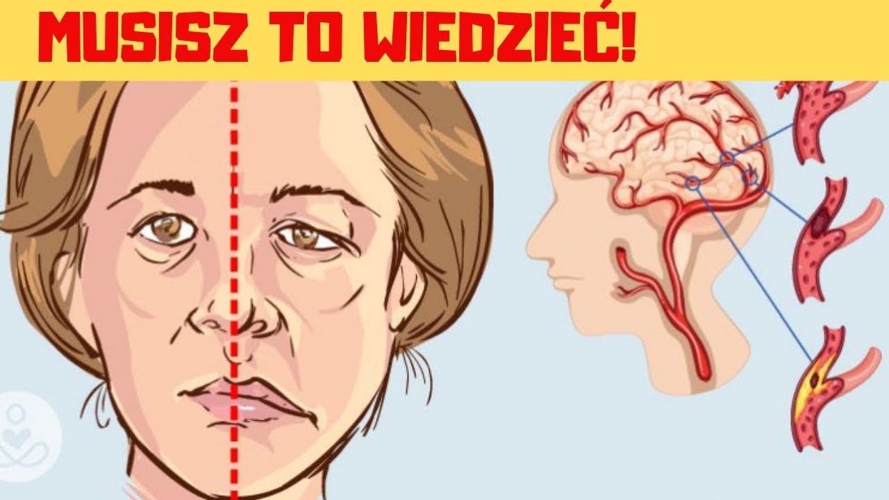 4 Objawy UDARU MÓZGU, które łatwo rozpoznasz – obejrzyj i zapamiętaj Udar Niedokrwienny Pnia Mózgu Rokowania
