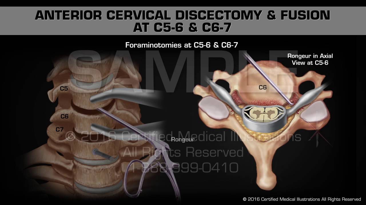 Anterior Cervical Discectomy & Fusion at C5-6 & C6-7 - YouTube Film 8 Klasiści Nie Płaczą Cda