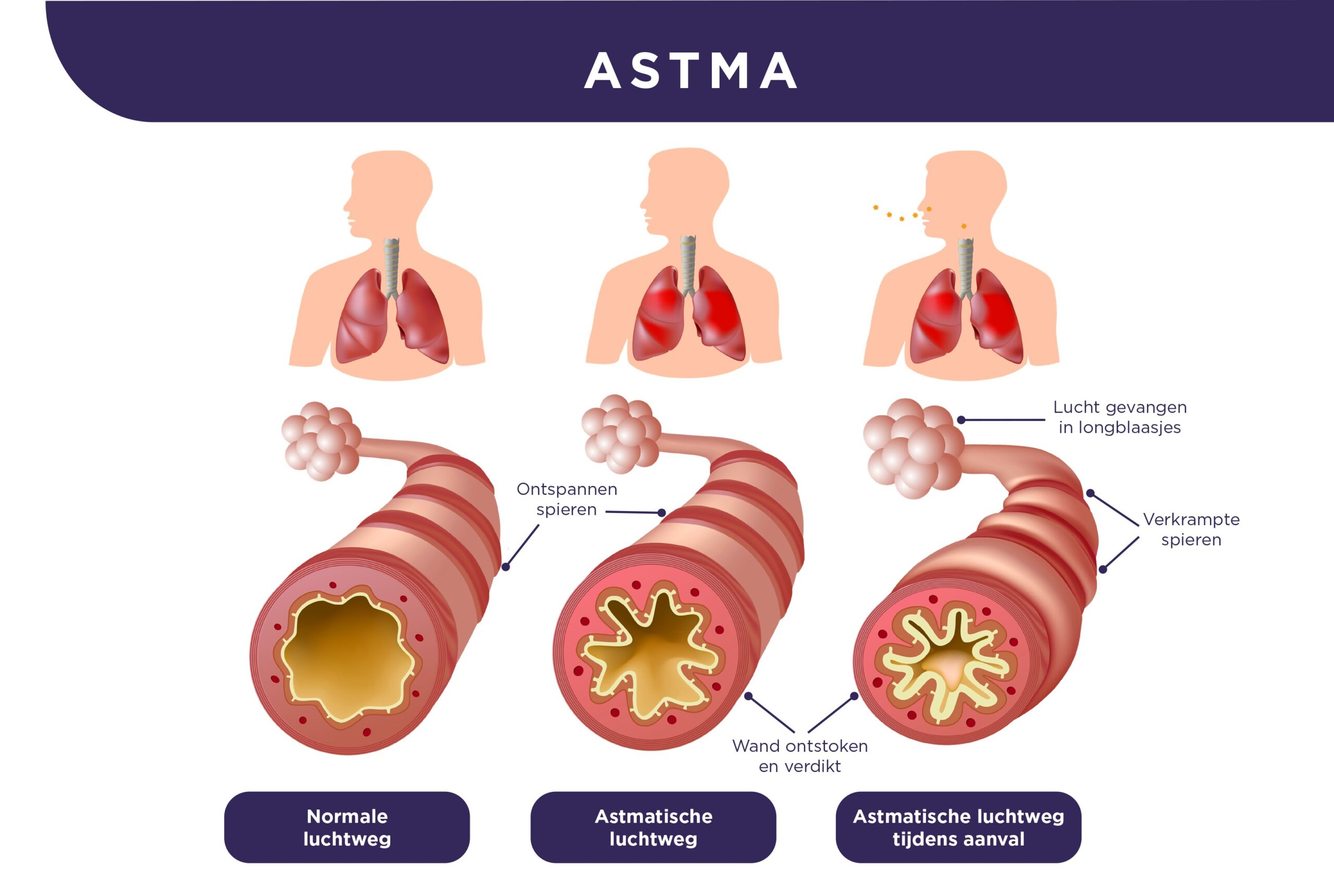 Astma - Wilbrink Wassink Fysiotherapie Astma Alergiczna A Astma Oskrzelowa