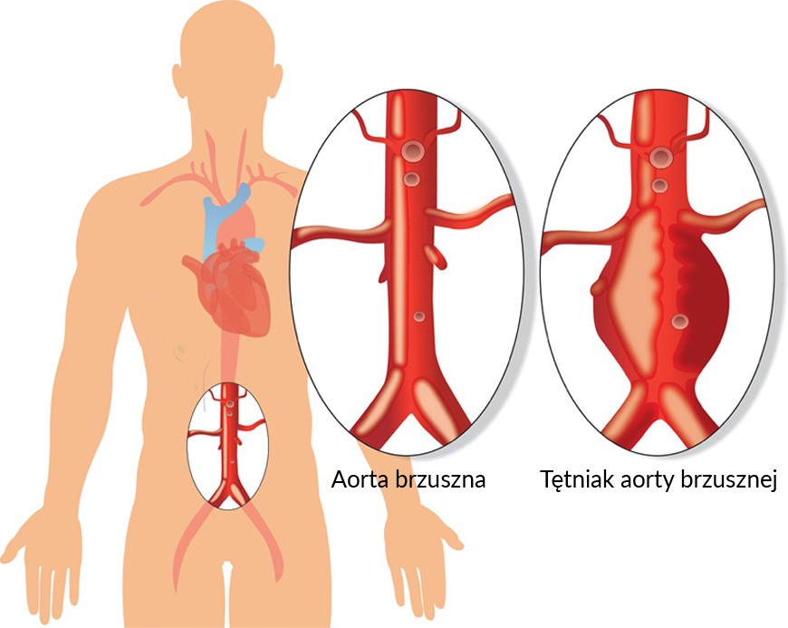 Bezpłatne badanie USG aorty brzusznej Pulsowanie Aorty Brzusznej W Ciazy