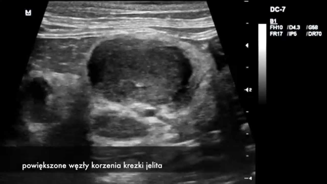 Biopsja pod kontrolą USG - YouTube Wynik Biopsji Tarczycy Kategoria 1