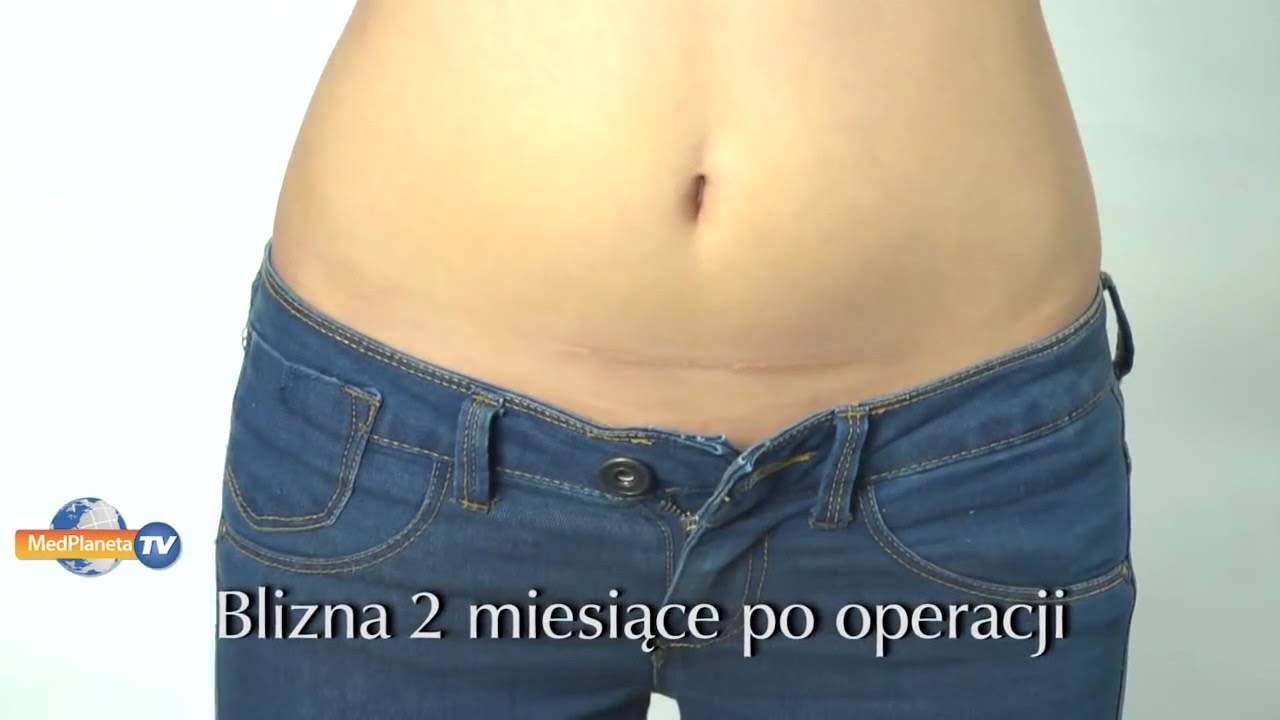 Blizny po cesarskim cięciu. Terapia - YouTube Przepuklina Kresy Bialej Icd 10