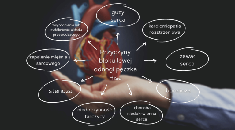 Blok lewej odnogi pęczka Hisa – objawy i leczenie schorzenia • Ratownik Blok Lewej Odnogi Peczka Hisa A Stres