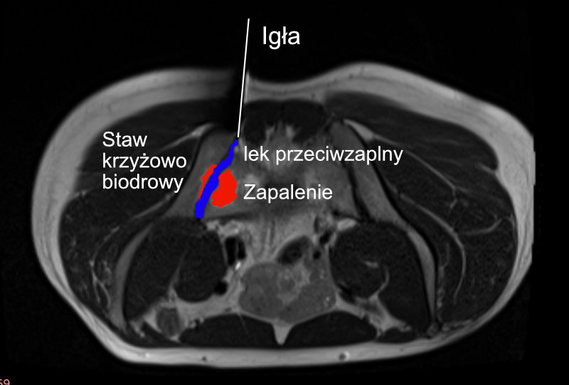 Blokada stawu krzyżowo biodrowego pod kontrolą rezonansu magnetycznego Jak Samemu Odblokowac Staw Krzyzowo Biodrowy