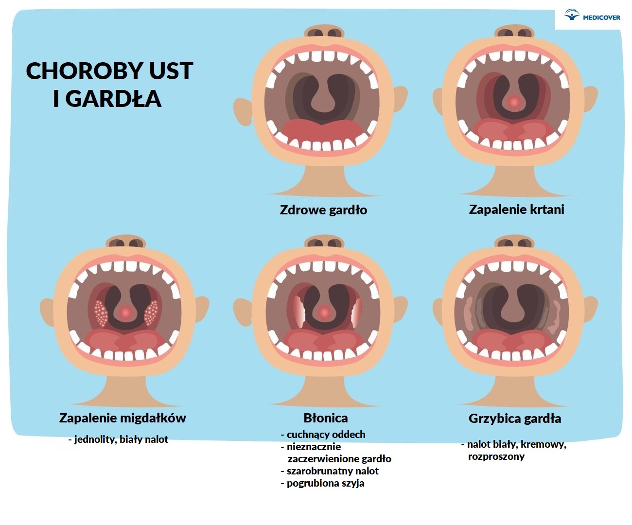 Błonica | Rodzaje, objawy i leczenie błonicy Blona Nasiatkowkowa Objawy I Leczenie