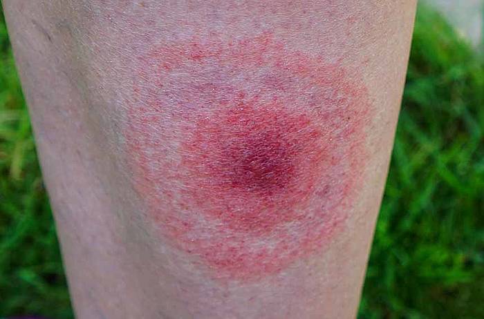 Borelioza | Objawy, diagnostyka, leczenie, skutki Jak Odroznic Borelioze Od Rzs