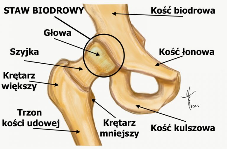 Nadbudowa Stropu Panewki Stawu Biodrowego