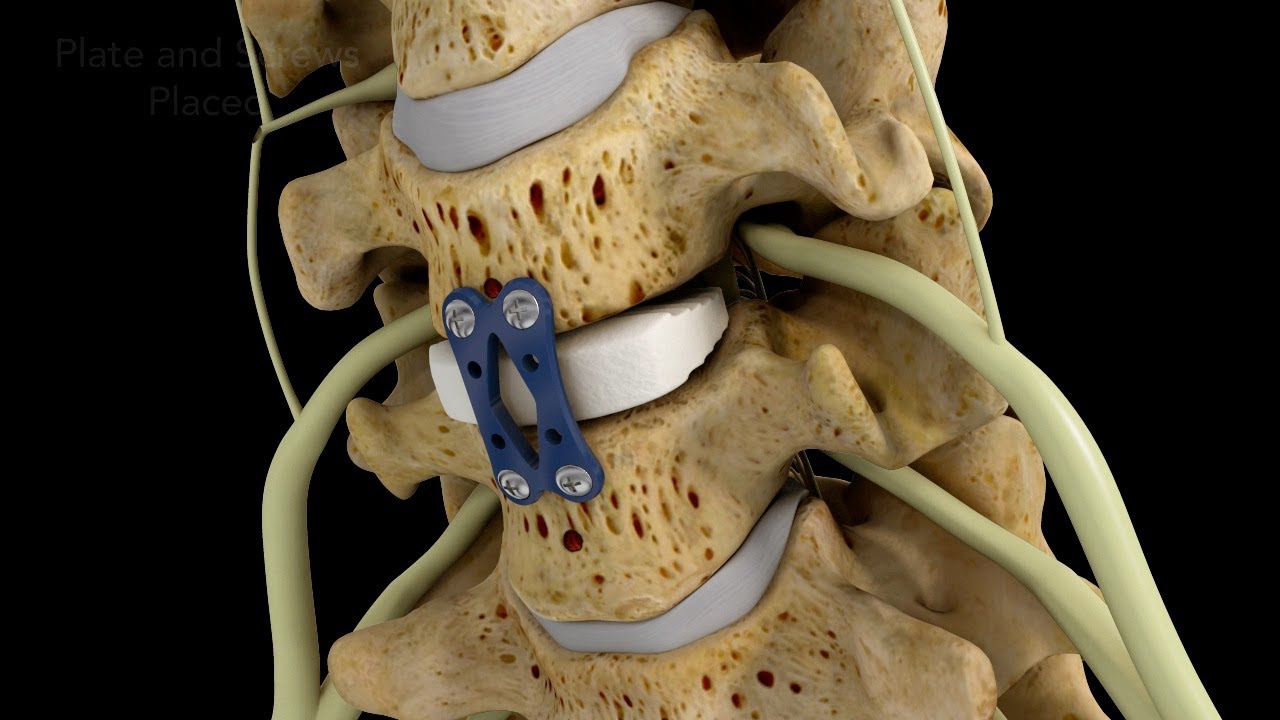 C4-5 Anterior Cervical Diskectomy with Fusion - YouTube Jakich środków Nie Można Używać Do Czyszczenia Ubrania Gazoszczelnego
