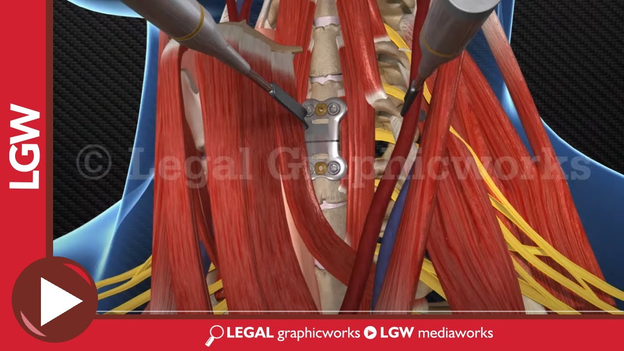 C4 C5 Neck Surgery Nierówne Fałdki Na Nóżkach U Niemowląt