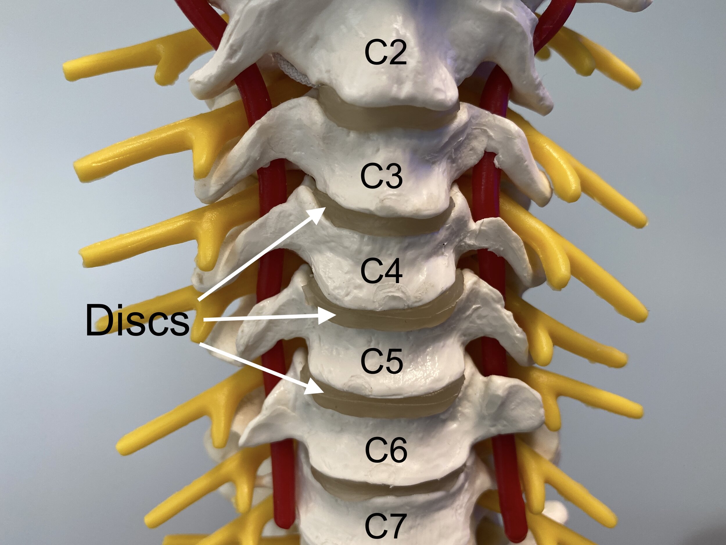 Cervical Disc Replacement — Matthew Mian, MD Wzor Na Przekatna Szesciokata Foremnego