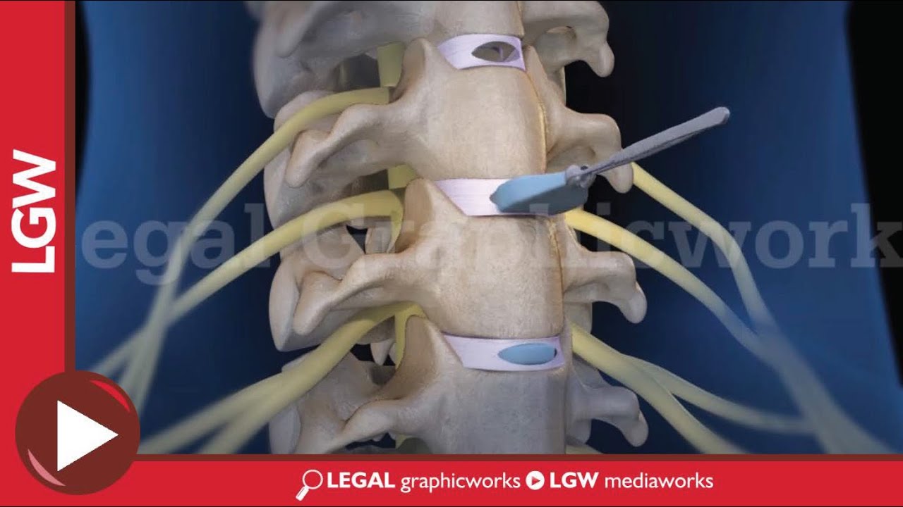 Cervical Discectomy & Fusion Surgery 3D animation C3 C4 C5 C6 - YouTube Jak Sprawdzić Który Ułamek Jest Większy