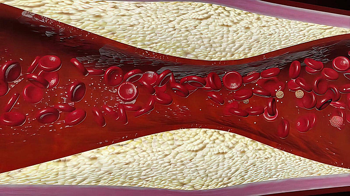 Stosunek Cholesterolu Całkowitego Do Hdl