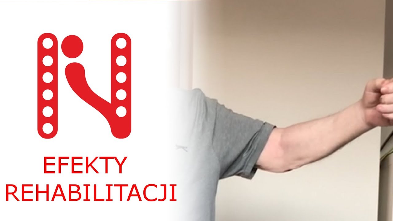 Ćwiczenia ręki po udarze - efekty rehabilitacji. - YouTube Zalecenia Dla Pacjenta Po Udarze Mózgu