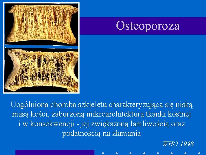 Dariusz Chmielewski Marcin Zgoda Choroby metaboliczne tkanki kostnej Torbielowate Rozrzedzenie Tkanki Kostnej Choroby