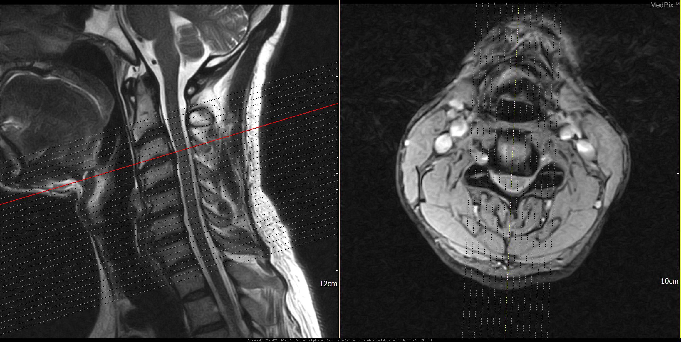 Disc Herniation Mri Mgły Wachlarzem Nie Rozpędzisz Baśń