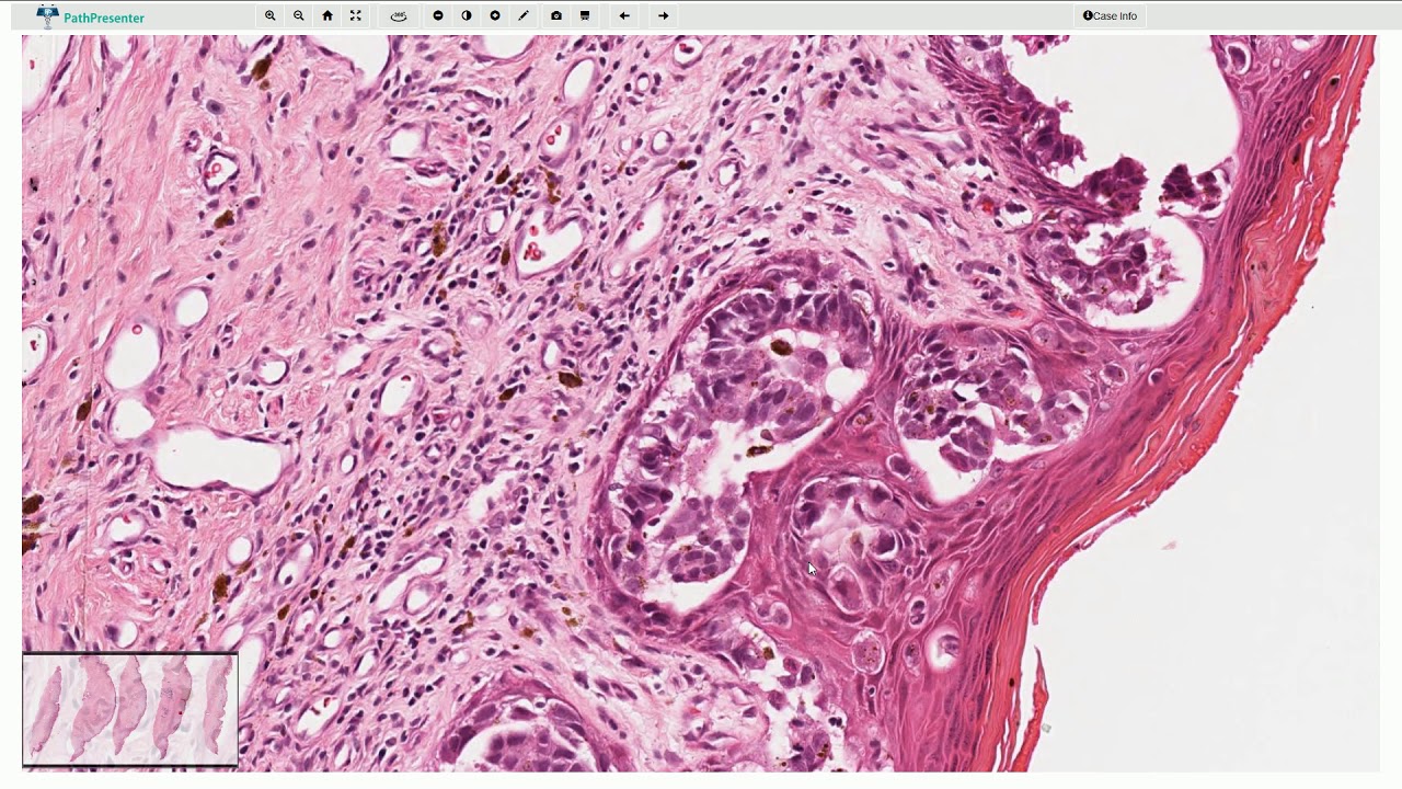 Ductal carcinoma in situ (DCIS) and Paget Disease - Histopathology Rak Przewodowy In Situ Dcis G2