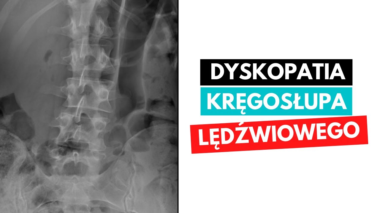 DYSKOPATIA - przepuklina krążka międzykręgowego - CZYNNIKI RYZYKA Przepuklina Kresy Bialej Icd 10