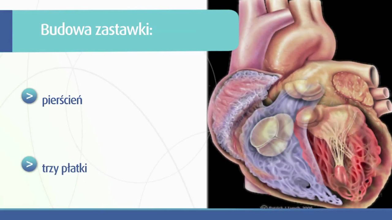 Sztuczna Zastawka Serca Czyli życie Z Zegarkiem