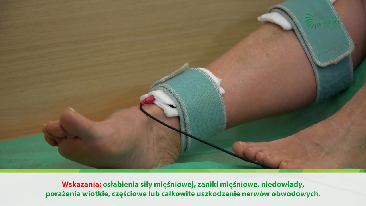 Elektrostymulacja Nerwu Strzalkowego Ulozenie Elektrod