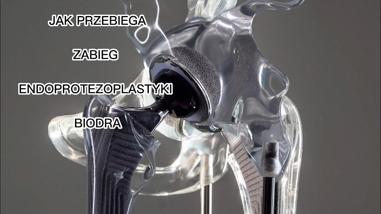 Endoprotezoplastyka biodra. Jak przebiega zabieg? - YouTube Endoprotezoplastyka Stawu Biodrowego Praca Licencjacka