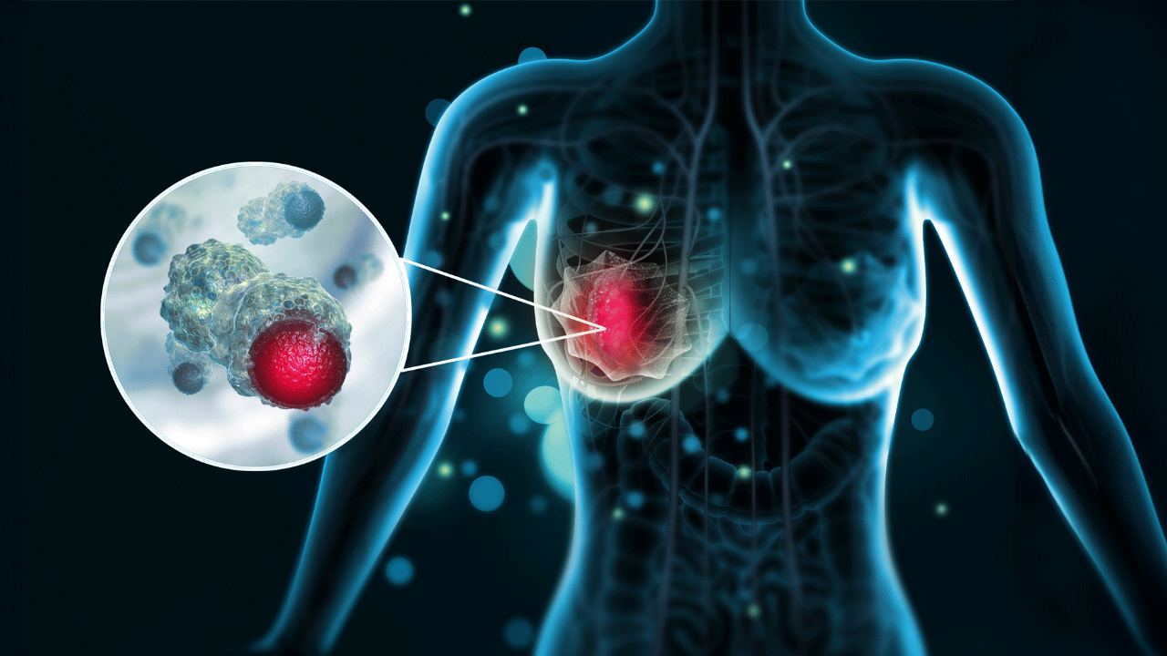 Episode 5: Sequencing of ADCs for Metastatic HER2-Low Disease Statystyki Zachorowań Na Raka Piersi W Polsce