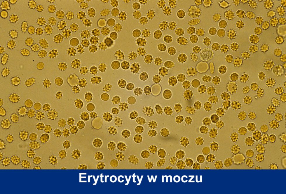 Erytrocyty w moczu: co oznaczają i jak leczyć? | ReceptaX Erytrocyty Swieze W Moczu 10 20