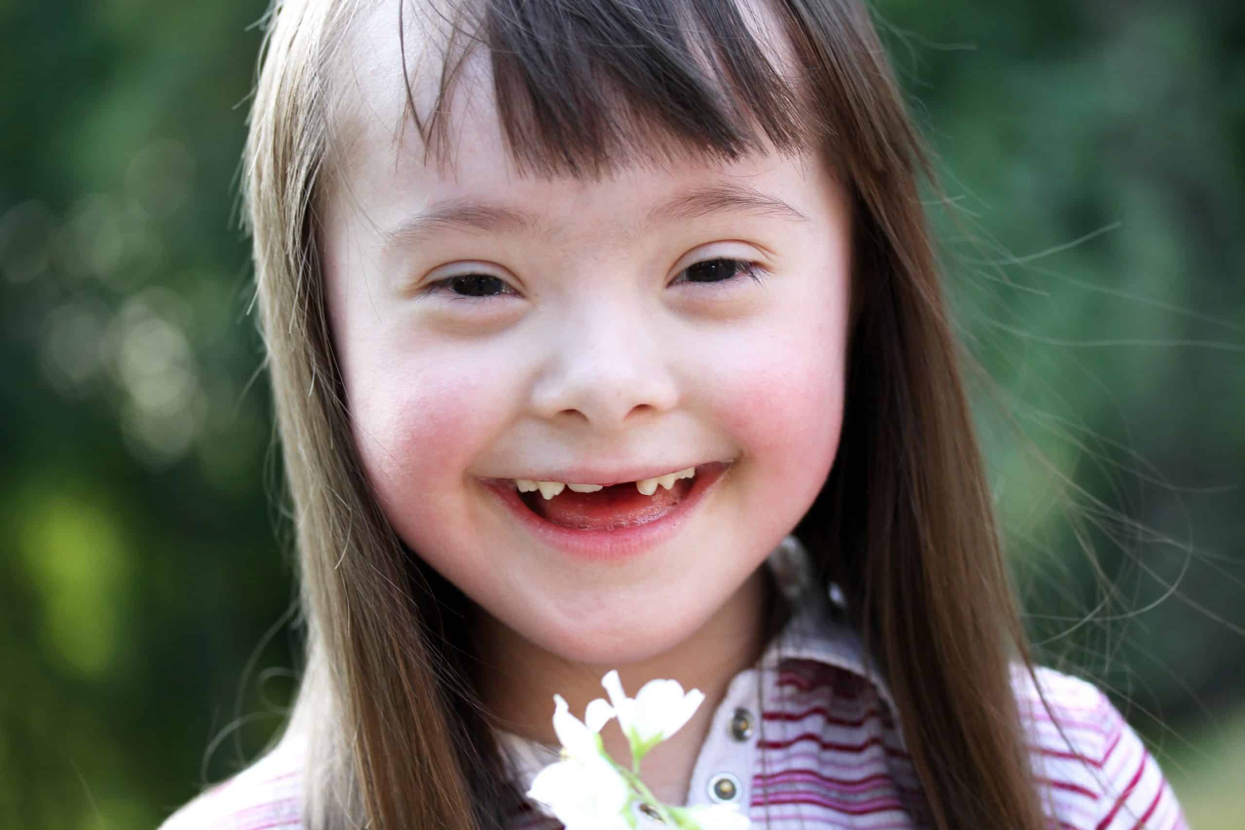 Everything You Need To Know About Down Syndrome | Dev Ped Titas Wspomaganie Rozwoju Dzieci Z Zespołem Downa Teoria I Praktyka Chomikuj