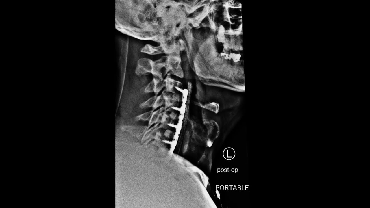Four Level Fusion ACDF C3-C7: Day 11 Post Surgery - YouTube Wpływ Pór Roku Na życie W Lesie
