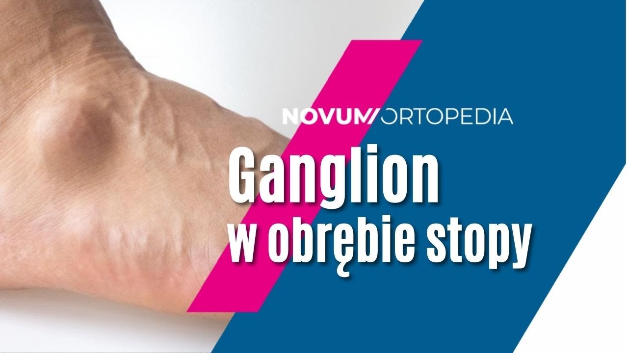 Ganglion: czym jest i jak sobie z nim poradzić | Novum Ortopedia - YouTube Co To Jest Guzek Podoplucnowy