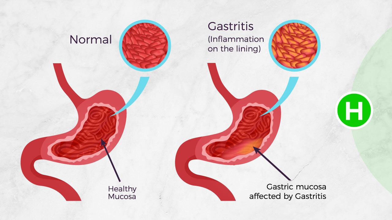 Gastritis Chronica Simplex Mediocris Gradus
