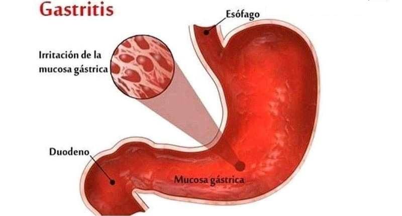 Gastritis: Efectos secundarios, tratamientos, síntomas - Unisima.com Gastritis Chronica Simplex Mediocris Gradus