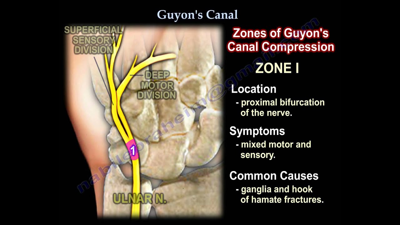 Guyon's Canal , Ulnar tunnel syndrome .Everything You Need To Know - Dr Zespół Kanału De Guyona Choroba Zawodowa