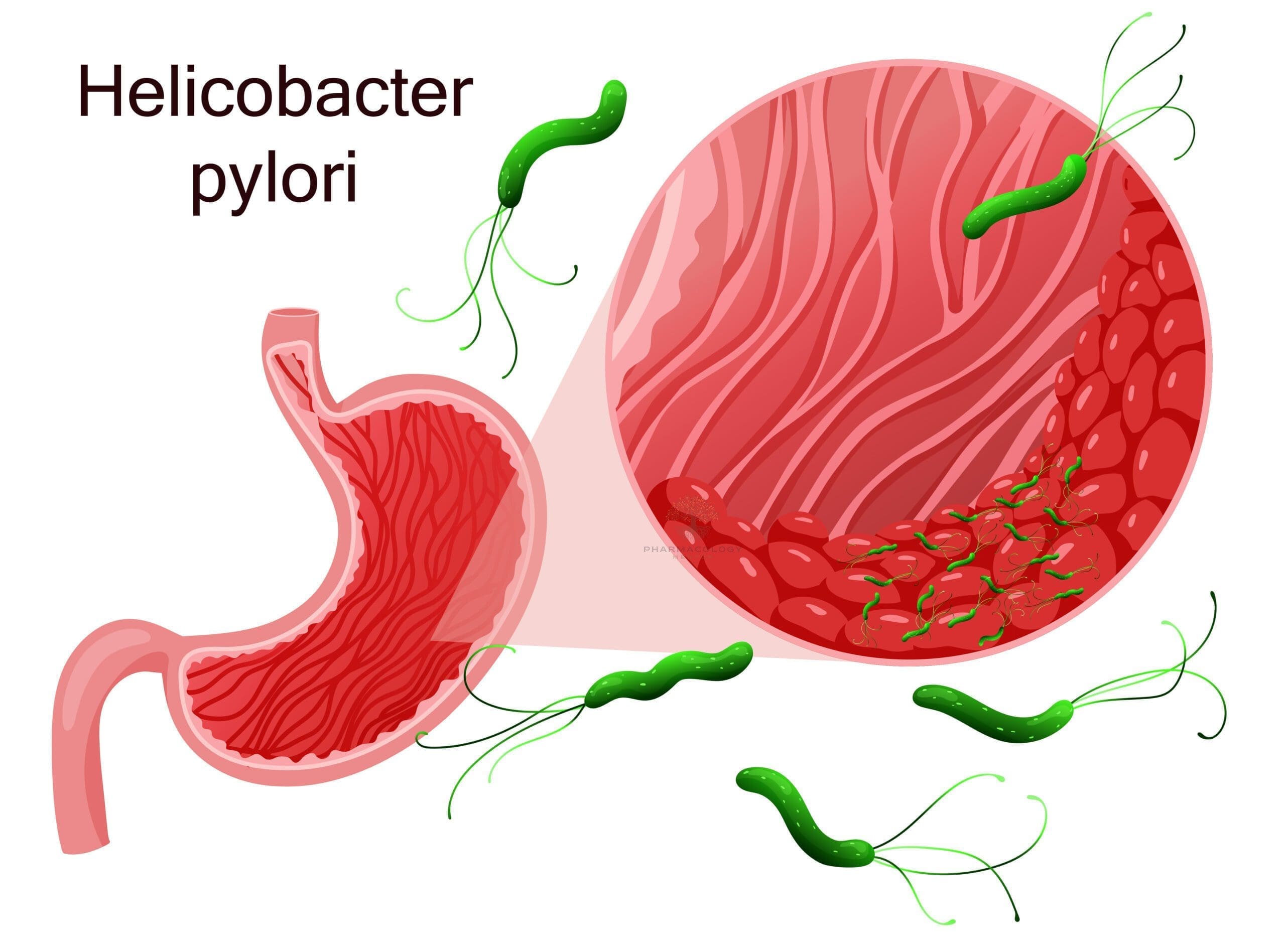 Helicobacter pylori Infection | Pharmacology Mentor Infekcja Helicobacter Pylori Icd 10