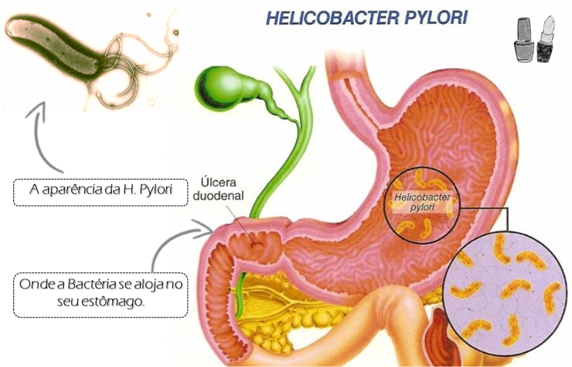 Infekcja Helicobacter Pylori Icd 10