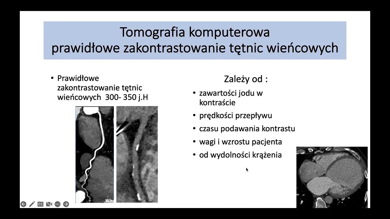 I. Michałowska - Diagnostyka tętnic wieńcowych w TK - YouTube Powiklania Po Operacji Tetniaka Mozgu