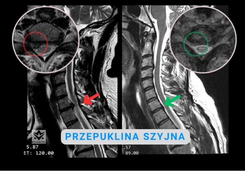 Jak rehabilitować przepuklinę szyjną kręgosłupa - Rehmedis.pl Kat Wiekszy Od Polpelnego A Mniejszy Od Pelnego