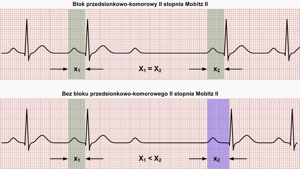 Kardiologia ratunkowa i nie tylko... : Rozpoznanie bloków przedsionkowo Blok Przedsionkowo Komorowy Ii Stopnia Typu Periodyki Wenckebacha