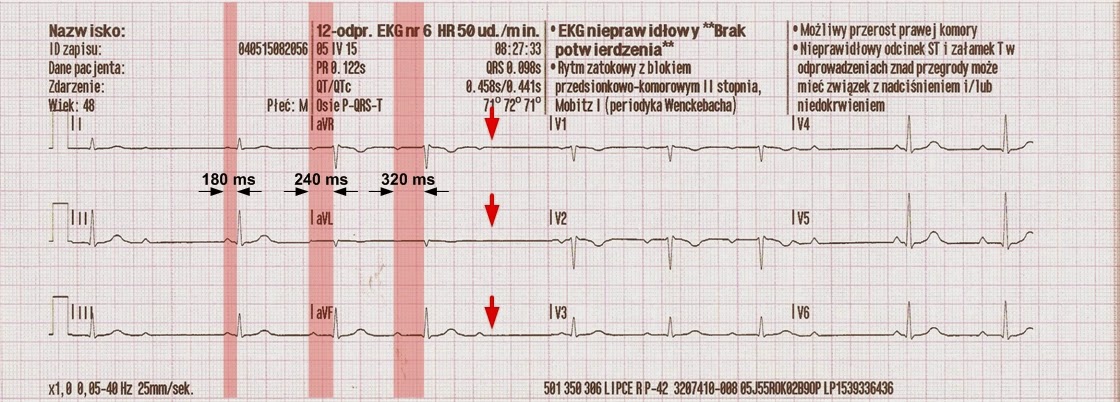 Kardiologia ratunkowa i nie tylko... : Rozpoznanie bloków przedsionkowo Blok Przedsionkowo Komorowy Ii Stopnia Typu Periodyki Wenckebacha