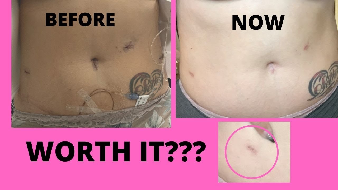 Laparoscopic Hysterectomy 5 week Post Op 😁 - YouTube Klipsy Po Laparoskopii Woreczka A Rezonans