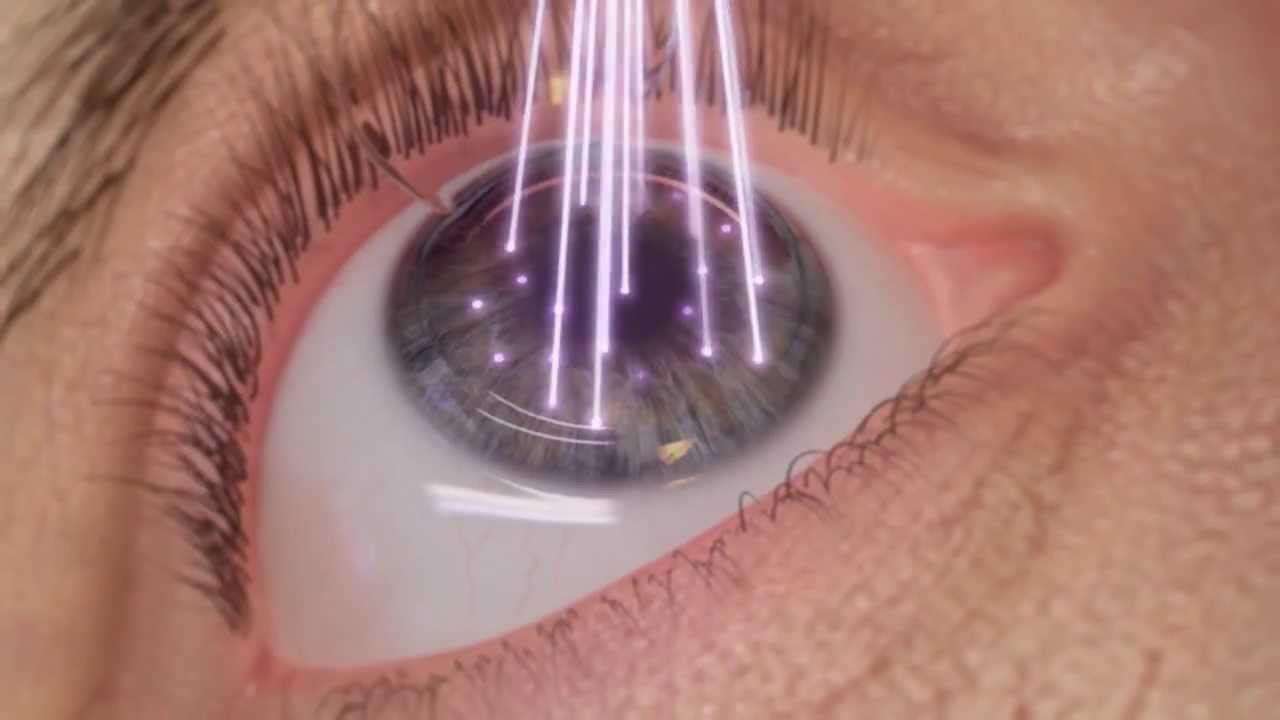 laserowa korekcja wzroku przy użyciu najszybszego na świecie LASERA Podstawy Refrakcji Oka I Korekcji Wad Wzroku Chomikuj