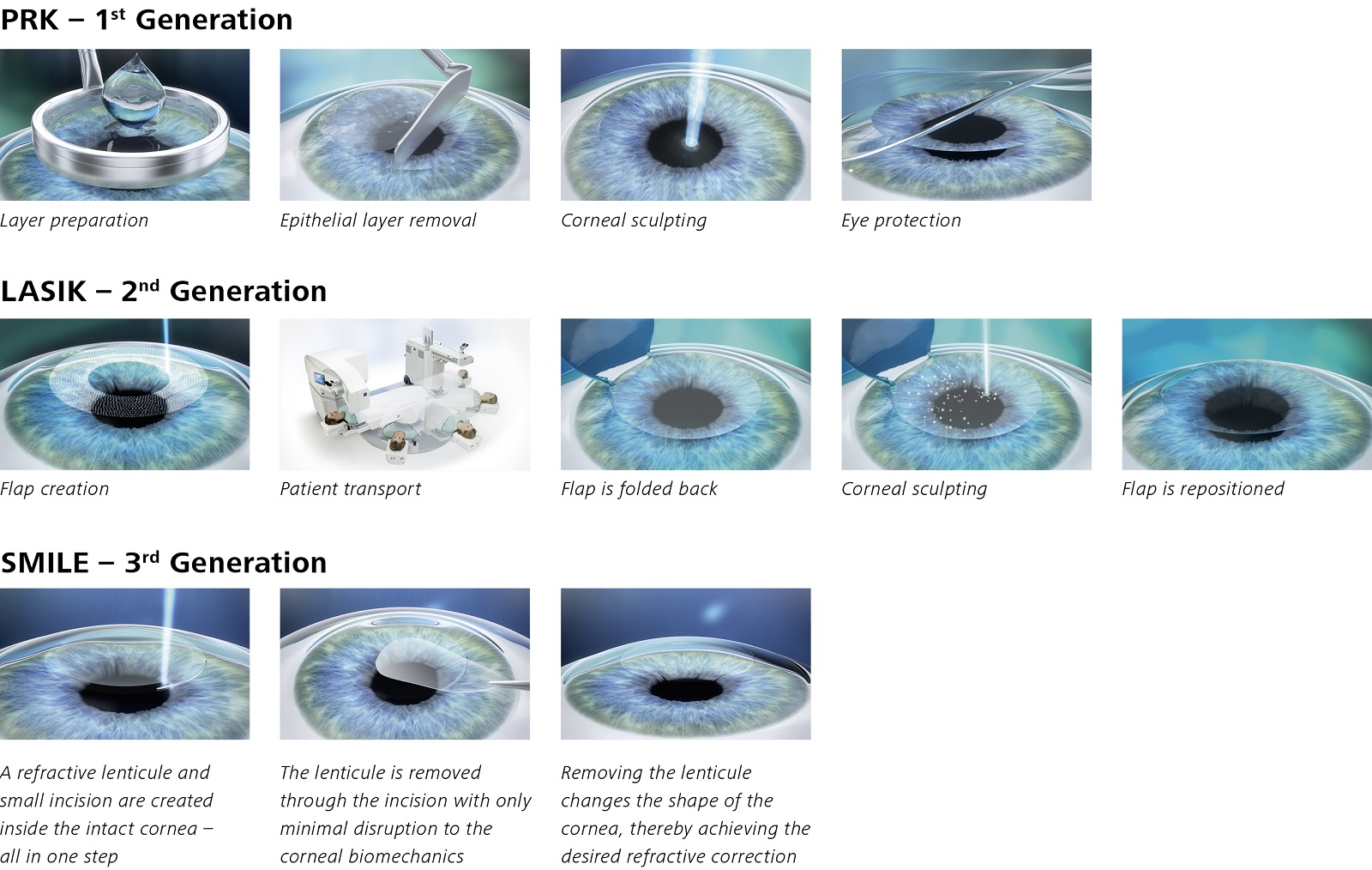 LASIK vs SMILE Laser Eye Surgery Czy Laser Jest Szkodliwy Dla Oczu