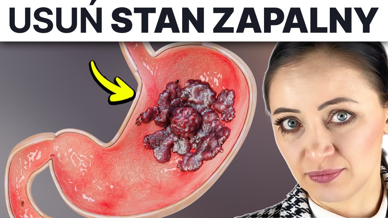 Lista * CO JEŚĆ * by usunąć stan zapalny żołądka i dwunastnicy - YouTube Profilaktyka Choroby Wrzodowej żołądka I Dwunastnicy