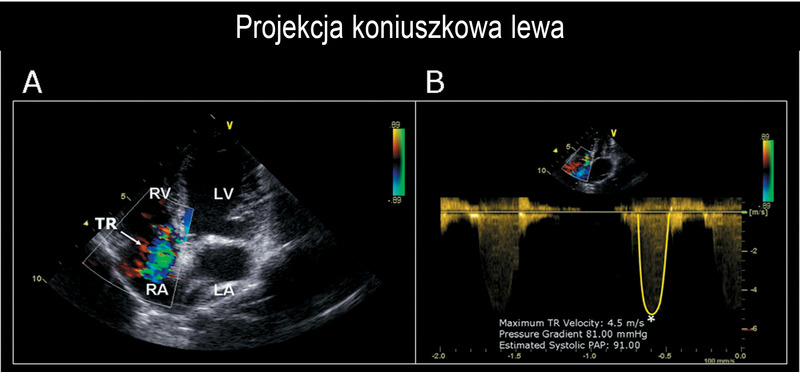Przeplyw Na Zastawce Trojdzielnej Nieprawidlowy Fala Wsteczna