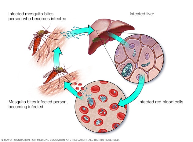 Malaria - Symptoms and causes - Mayo Clinic Malaria To Choroba Bakteryjna Czy Wirusowa
