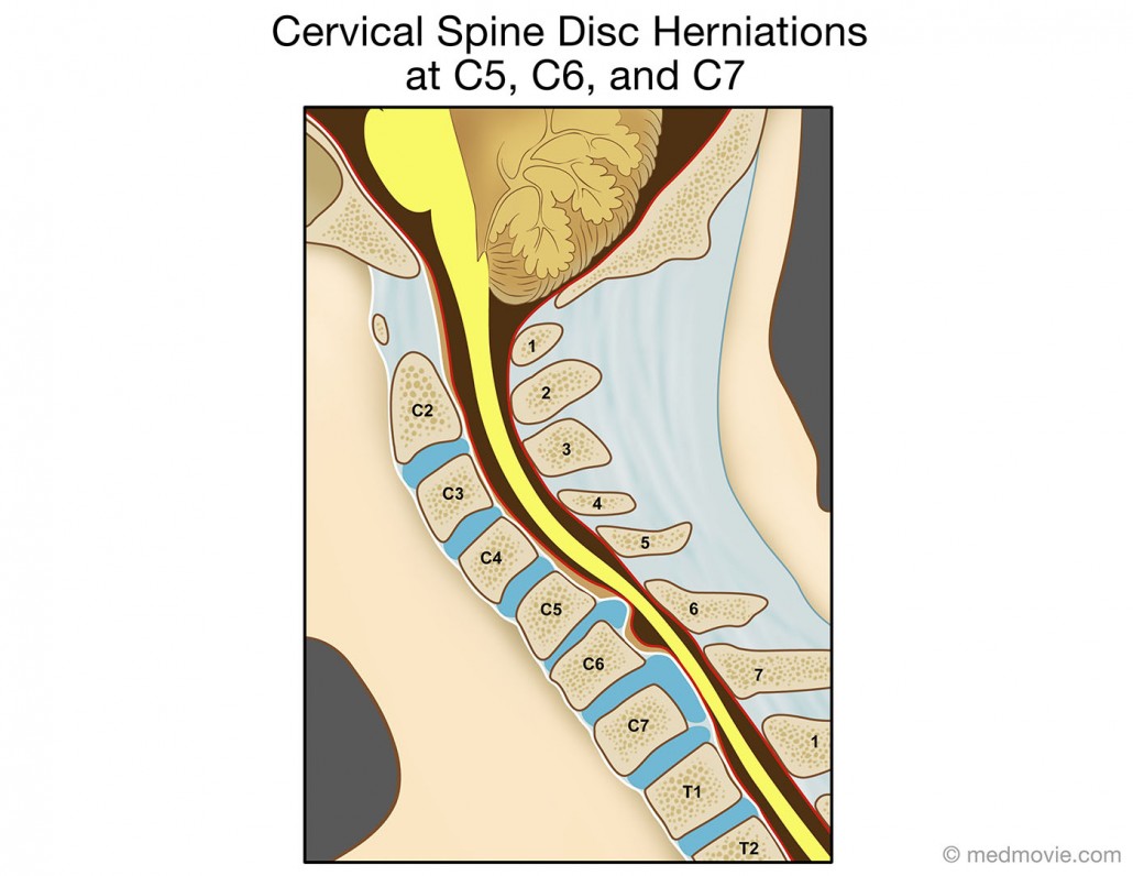 Medmovie.com | Cervical Spine Disc Herniations at C5, C6, and C7 Mieszkaniec Uzdrowiska Leżącego U Podnóża Gór Złotych