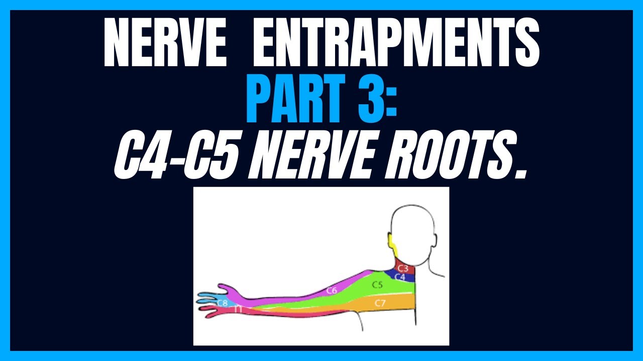 Nerve Entrapments Part 3: C4-C5 Nerve Roots. - YouTube Pierwszym Rokiem Trzeciego Tysiąclecia Był Rok