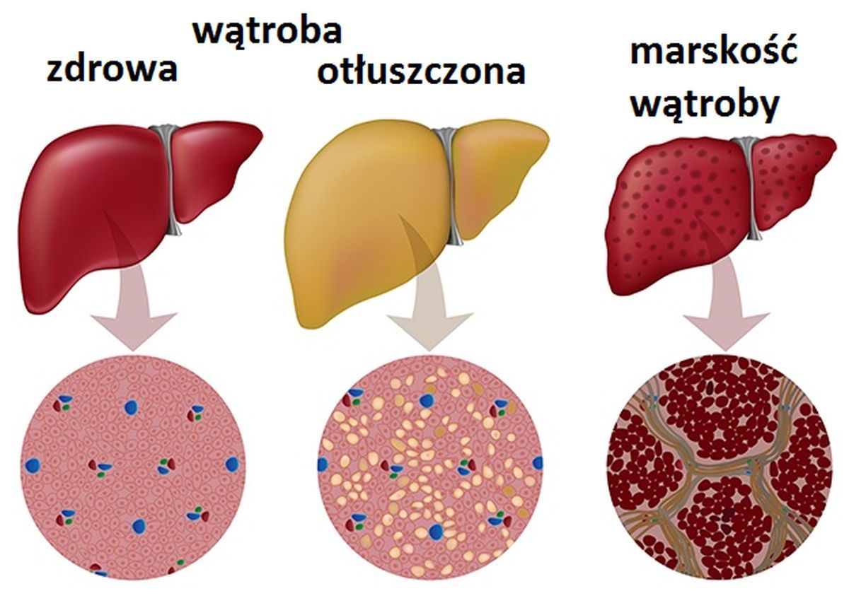 Co Oznacza Ziarnista Struktura Watroby