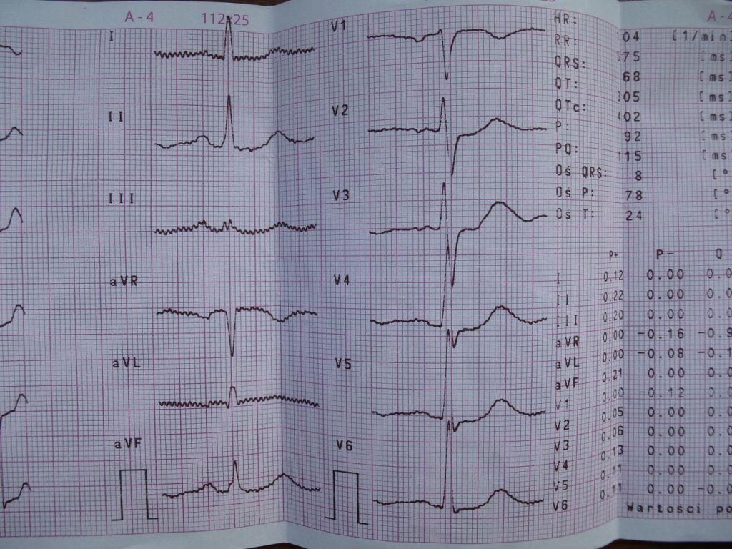 Odczyt EKG. Strona 1. ForumKardiologiczne.pl – portal wiedzy o kardiologii Niedokrwienie Podwsierdziowe Sciany Przedniej Objawy