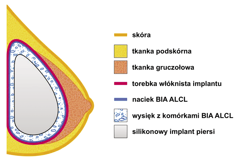 Torebka Wloknista Wokol Implantu Objawy